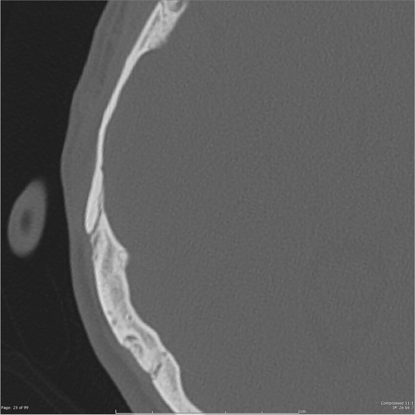 Acute otomastoiditis (Radiopaedia 28276-28512 Axial PTB bone window reformat 5).jpg