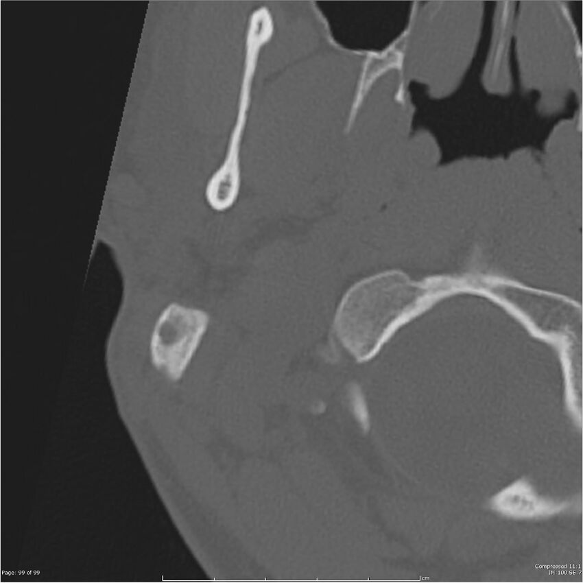 Acute otomastoiditis (Radiopaedia 28276-28512 Axial PTB bone window reformat 79).jpg