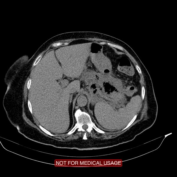 File:Acute pancreatitis with infected necrosis (Radiopaedia 26454-26585 Axial non-contrast 5).jpg