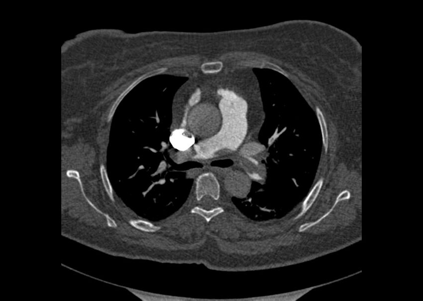 Acute pulmonary embolism (Radiopaedia 29938-30466 Axial C+ CTPA 49).jpg