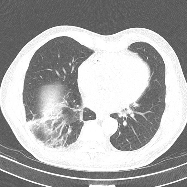 File:Acute pulmonary embolism (Radiopaedia 81677-95570 Axial lung window 30).jpg