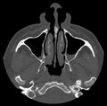 Acute sinusitis (Radiopaedia 23161-23215 Axial bone window 19).jpg