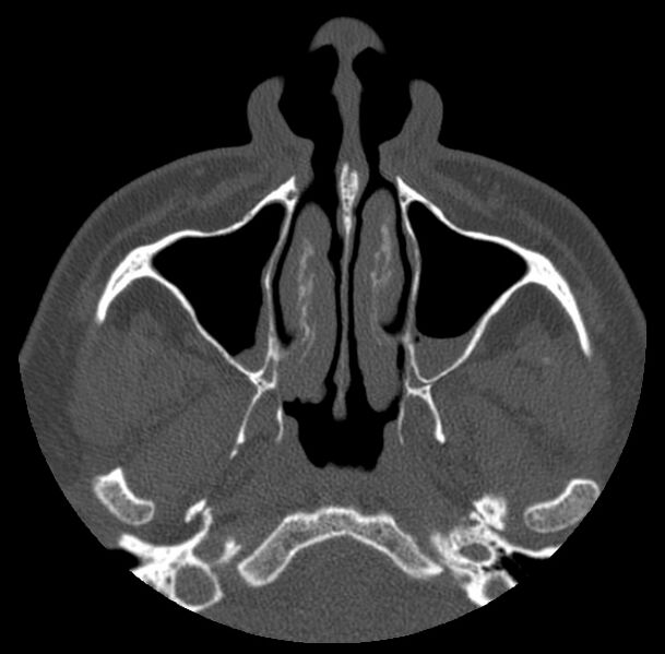 File:Acute sinusitis (Radiopaedia 23161-23215 Axial bone window 19).jpg