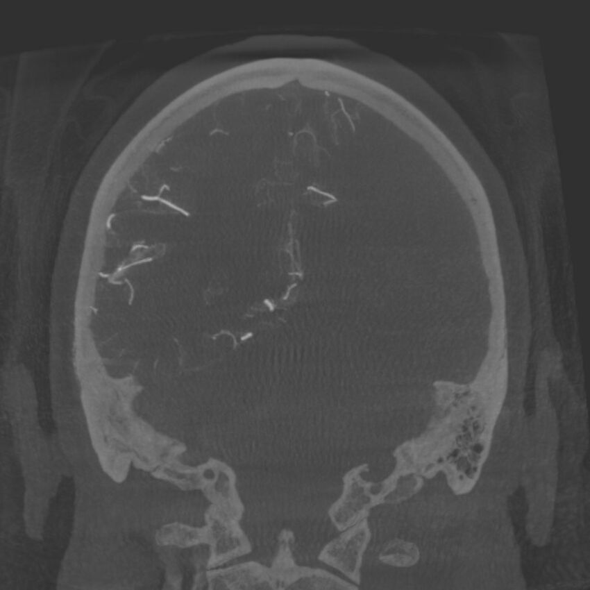 Acute subarachnoid hemorrhage and accessory anterior cerebral artery (Radiopaedia 69231-79010 Coronal arterial - MIP 72).jpg