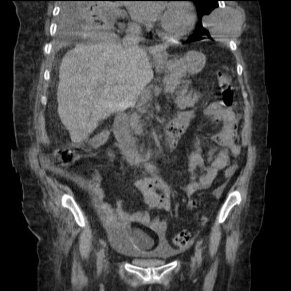 File:Acute tubular necrosis (Radiopaedia 28077-28334 D 41).jpg