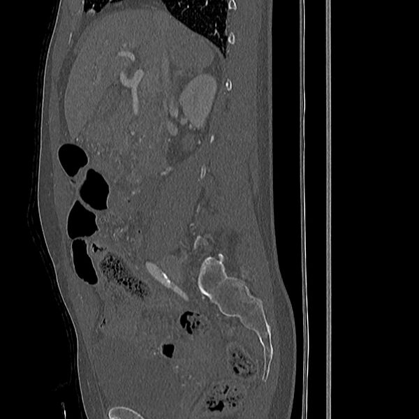 File:Acute vertebral body compression fractures (Radiopaedia 31757-32693 Sagittal bone window 43).jpg