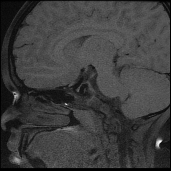 File:Adamantinomatous craniopharyngioma (Radiopaedia 77407-89529 Sagittal T1 fat sat 4).jpg