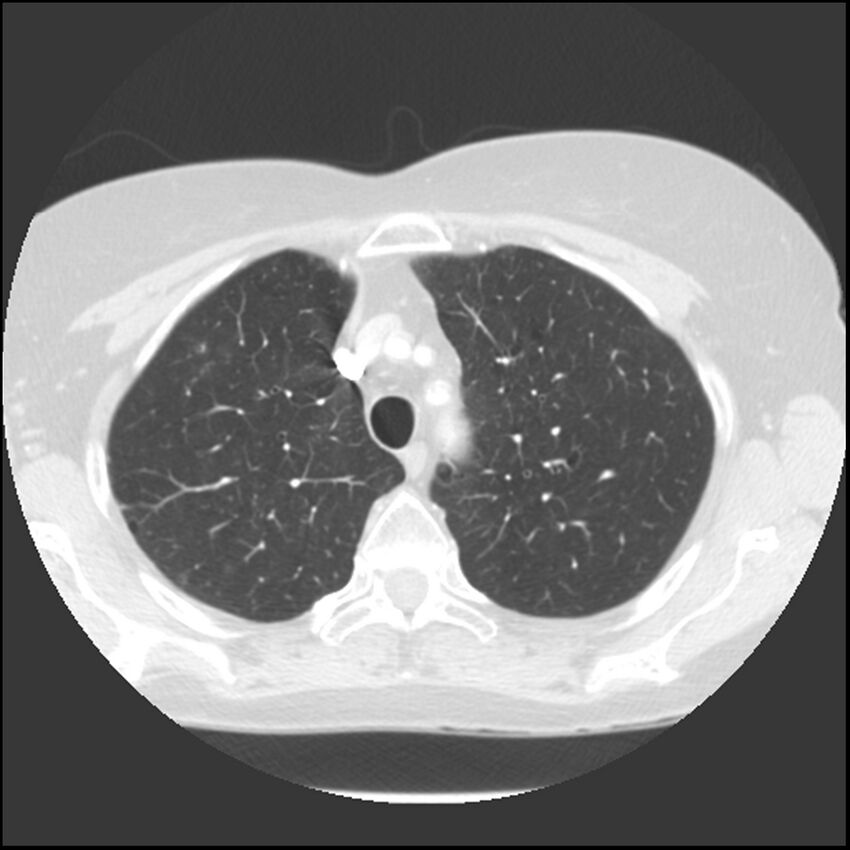 Adenocarcinoma of the lung (Radiopaedia 41015-43755 Axial lung window 29).jpg