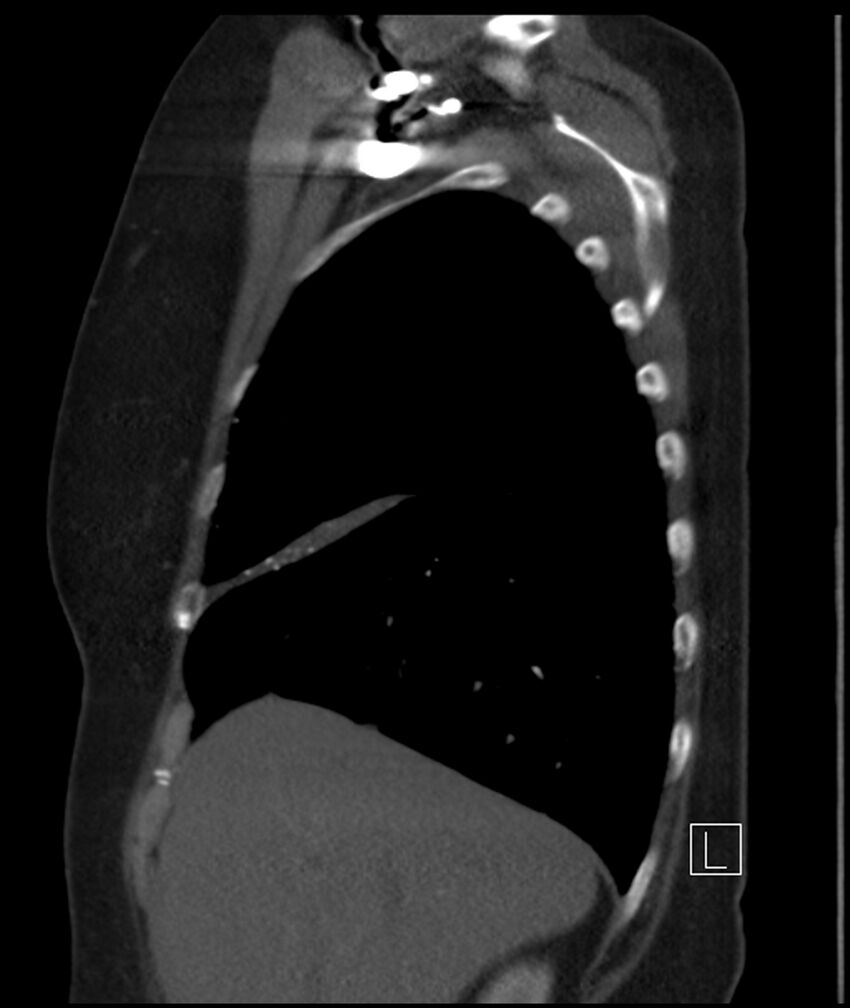 Adenocarcinoma of the lung (Radiopaedia 44205-47803 Sagittal C+ portal venous phase 44).jpg