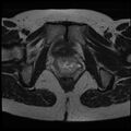Adenoma malignum of the cervix (Radiopaedia 24460-24765 C 23).jpg