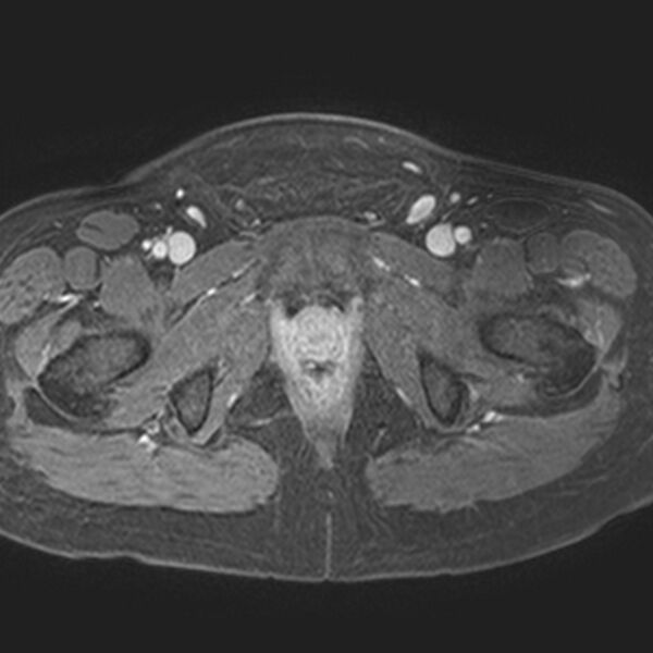 File:Adenomyoma of the uterus (Radiopaedia 9871-10439 Axial T1 C+ fat sat 4).jpg