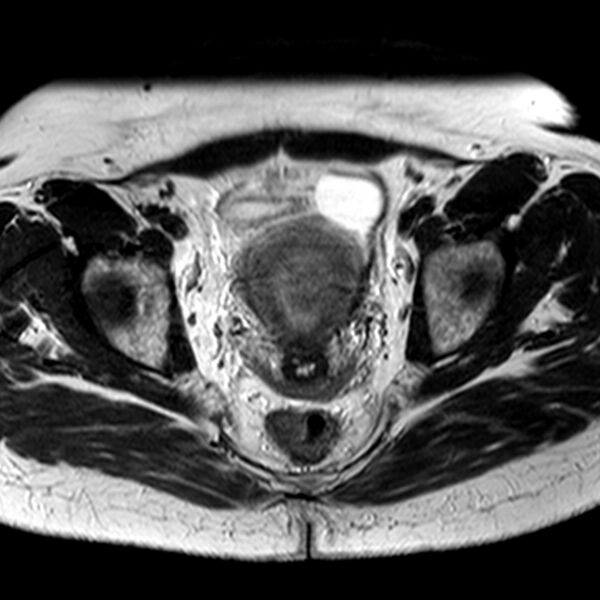 File:Adenomyoma of the uterus (Radiopaedia 9871-10439 Axial T2 14).jpg