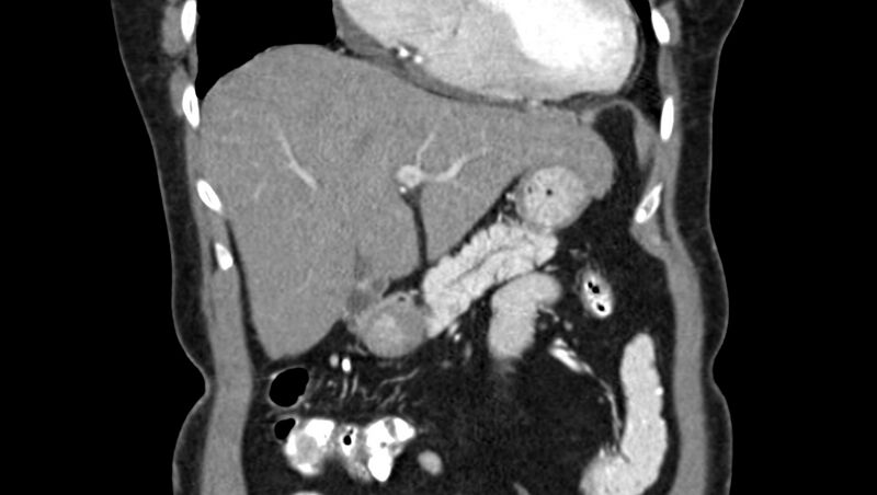 File:Adenomyomatosis of the gallbladder (Radiopaedia 12142-12483 Coronal C+ arterial phase 12).jpg