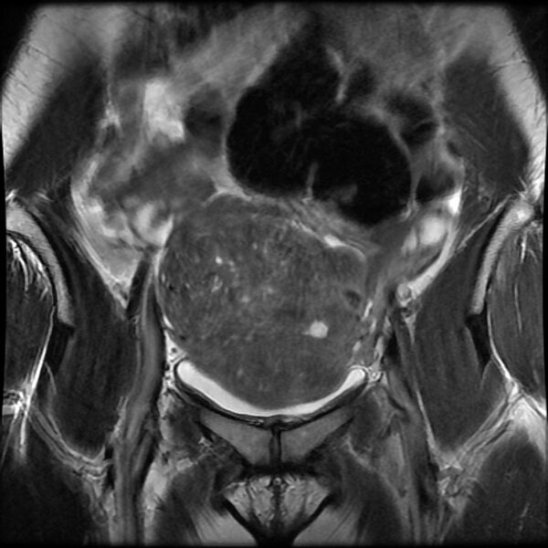 File:Adenomyosis on MRI (Radiopaedia 29328-29780 Coronal T2 13).jpg