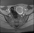 Adenomyosis with endometrioma (Radiopaedia 6753-7952 Axial T1 fat sat 1).jpg