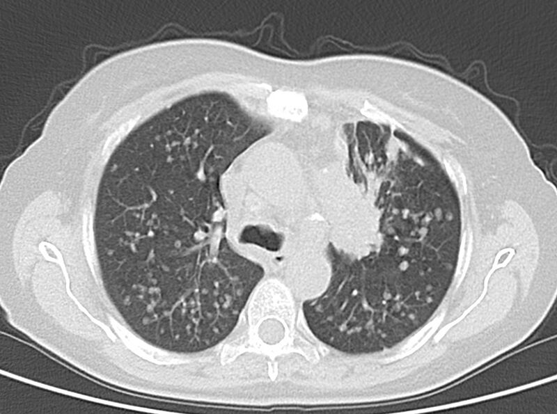 File:Adenosquamous lung carcinoma (Radiopaedia 22035-22030 lung window 26).jpg