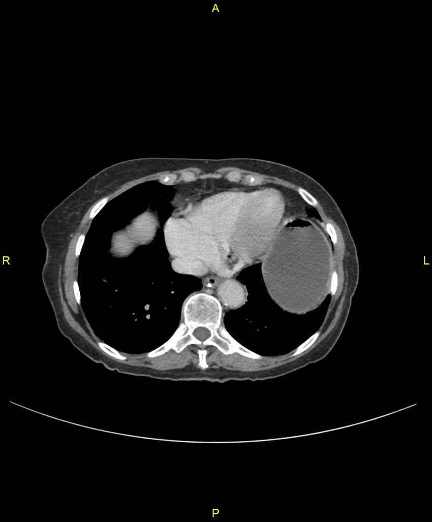 Adhesional small bowel obstruction (Radiopaedia 85402-101024 Axial C+ portal venous phase 17).jpg