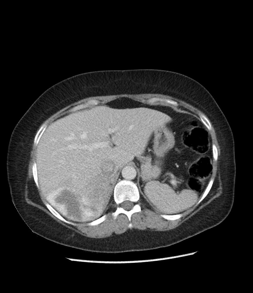 Adrenal cortical carcinoma with IVC invasion and thrombosis (Radiopaedia 34307-35597 Axial C+ portal venous phase 19).jpg