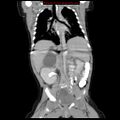 Adrenal hemorrhage (Radiopaedia 9390-10077 Coronal C+ portal venous phase 6).jpg