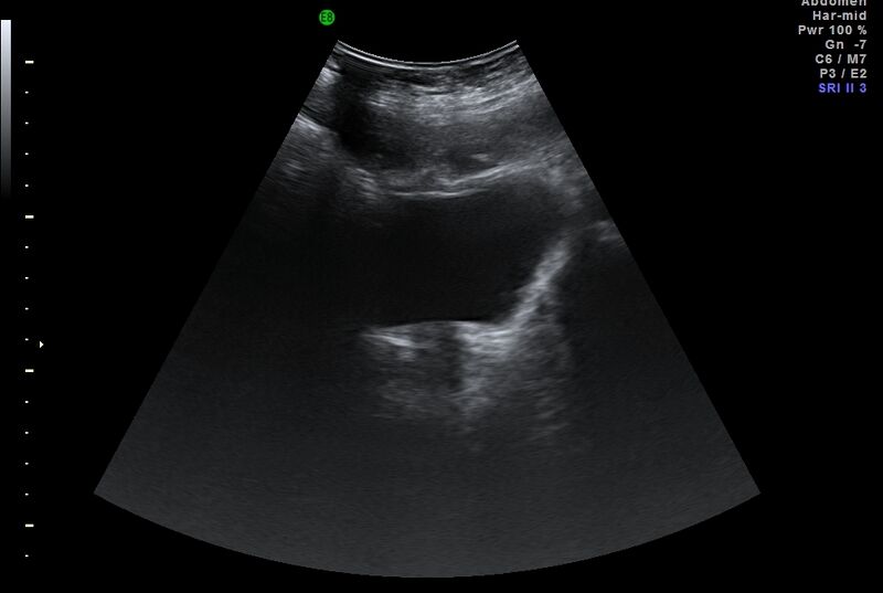 File:Adrenal myelolipoma - bilateral (Radiopaedia 74805-85811 Abdominal ultrasound 17).jpg