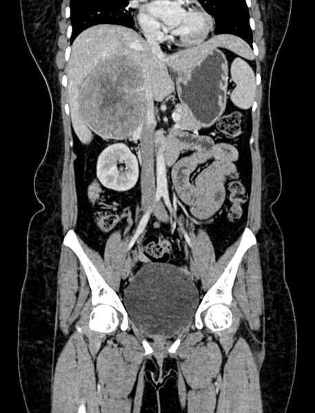 File:Adrenocortical carcinoma (Radiopaedia 87281-103569 Coronal C+ portal venous phase 38).jpg