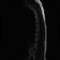 Aggressive vertebral hemangioma (Radiopaedia 39937-42404 Sagittal T2 14).png