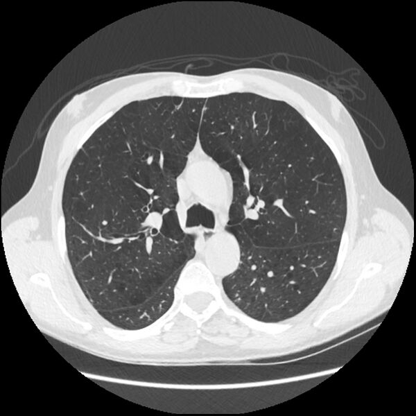 File:Alpha-1-antitrypsin deficiency (Radiopaedia 40993-43722 Axial lung window 83).jpg