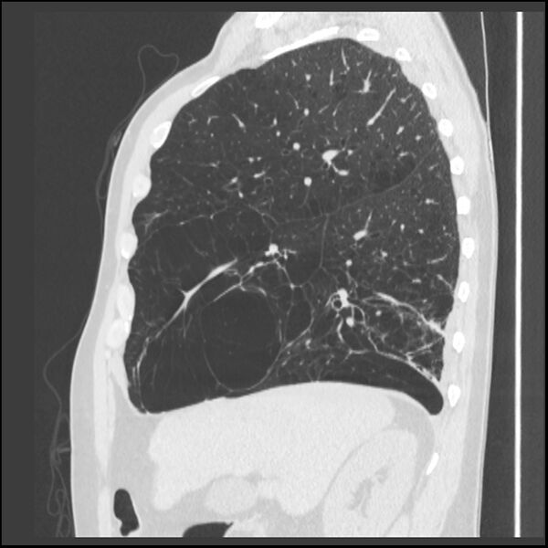 File:Alpha-1-antitrypsin deficiency (Radiopaedia 40993-43722 Sagittal lung window 189).jpg