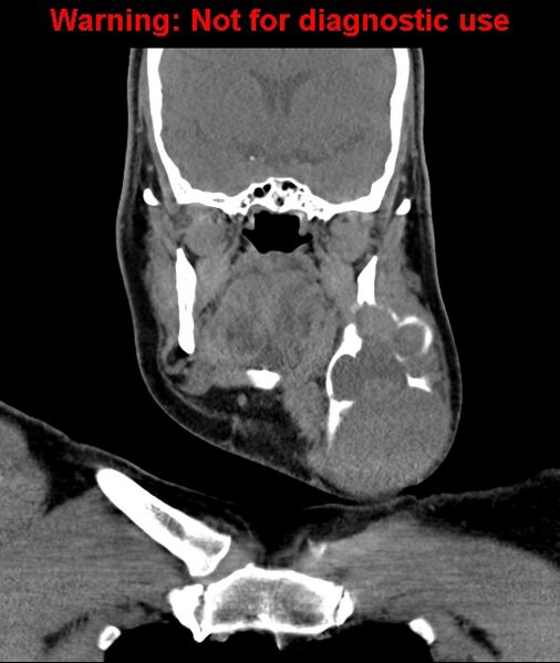 File:Ameloblastoma (Radiopaedia 33126-34164 D 34).jpg