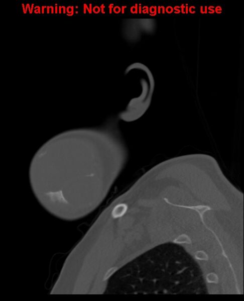 File:Ameloblastoma (Radiopaedia 33126-34164 Sagittal bone window 11).jpg