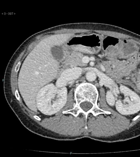 File:Ampulla of Vater metastasis (Radiopaedia 27820-28065 A 1).jpg