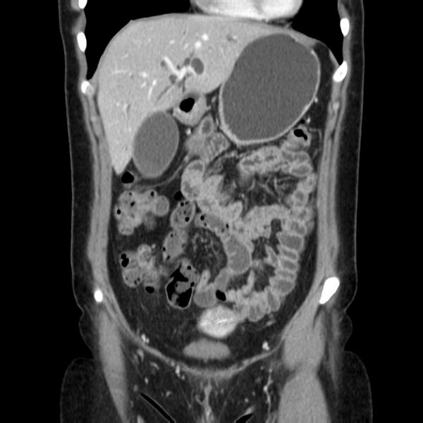 File:Ampullary tumor (Radiopaedia 22787-22816 E 18).jpg