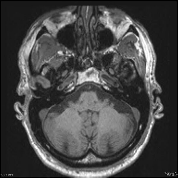 File:Anaplastic meningioma with recurrence (Radiopaedia 34452-35788 Axial T1 24).jpg