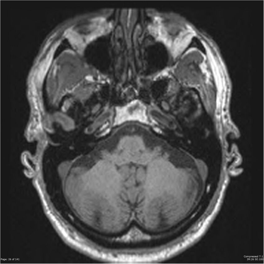 Anaplastic meningioma with recurrence (Radiopaedia 34452-35788 Axial T1 24).jpg