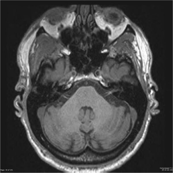 File:Anaplastic meningioma with recurrence (Radiopaedia 34452-35788 Axial T1 28).jpg