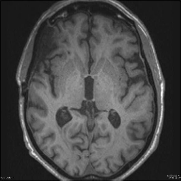 File:Anaplastic meningioma with recurrence (Radiopaedia 34452-35788 Axial T1 67).jpg