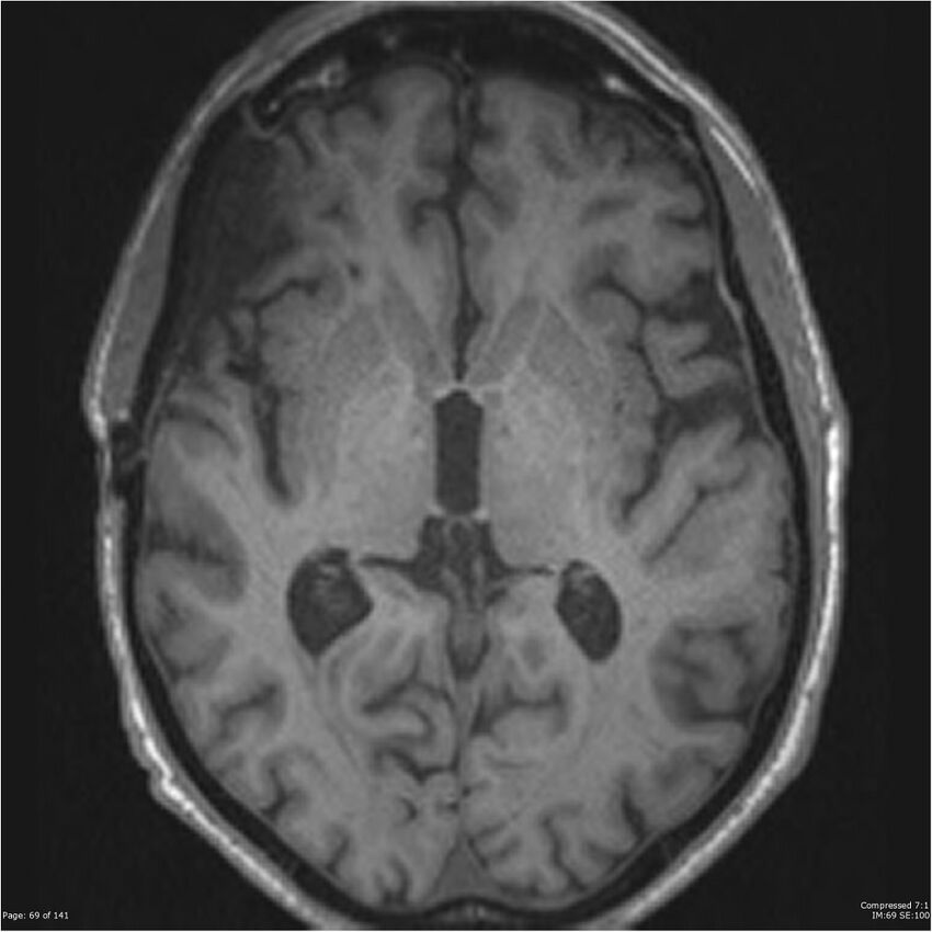 Anaplastic meningioma with recurrence (Radiopaedia 34452-35788 Axial T1 67).jpg