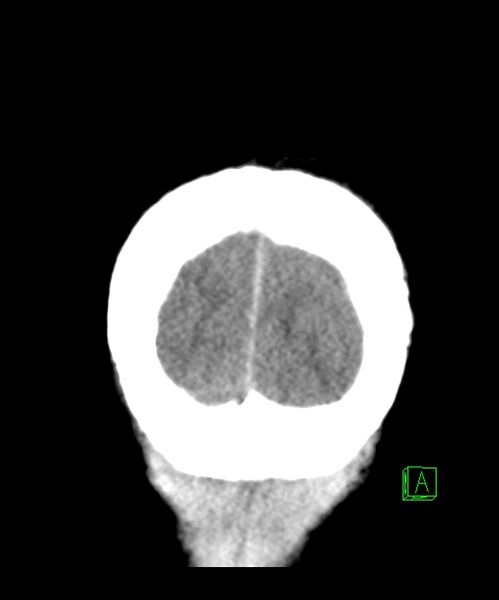 File:Angiomatous meningioma (Radiopaedia 79459-92578 Coronal non-contrast 34).jpg