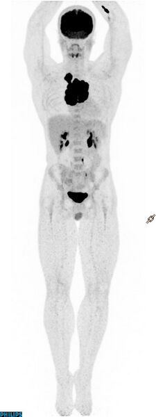File:Anterior mediastinal seminoma (Radiopaedia 80270-93613 A 1).jpg