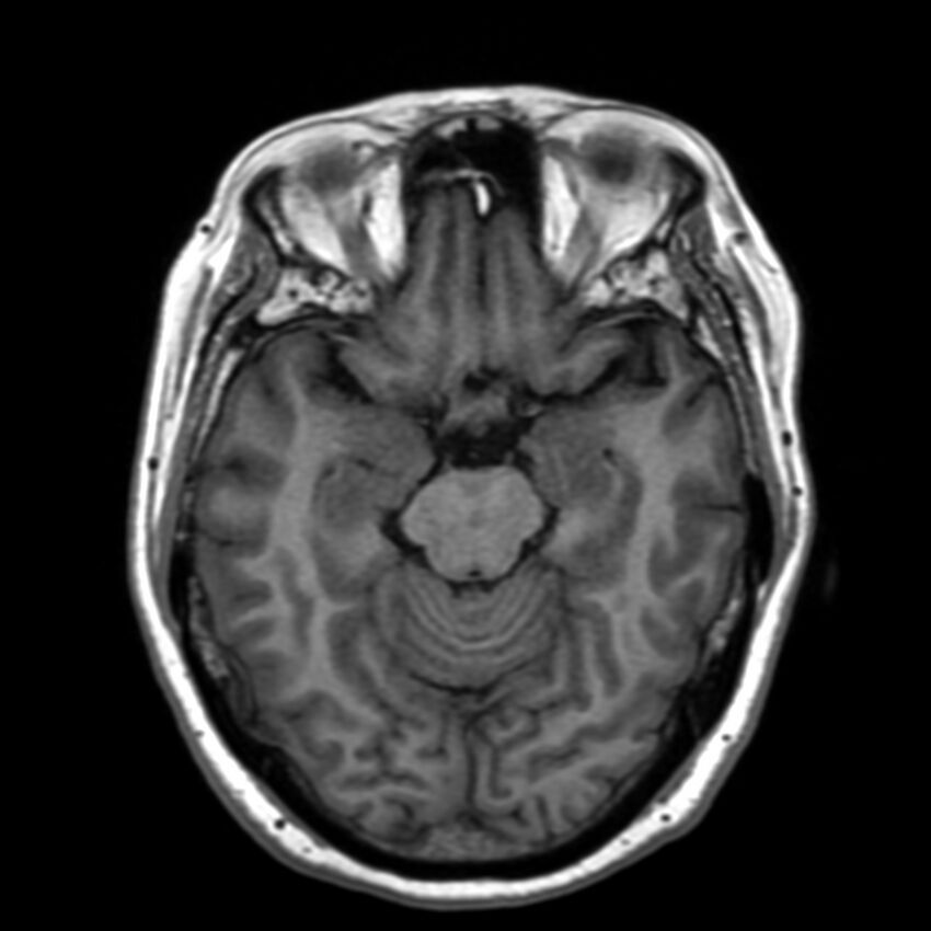 Anti-MOG encephalomyelitis (Radiopaedia 73831-84646 Axial T1 20).jpg