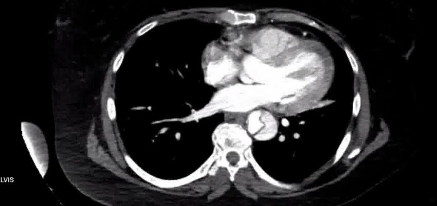 Aortic Dissection (Radiopaedia 85272-100847 A 29).jpg