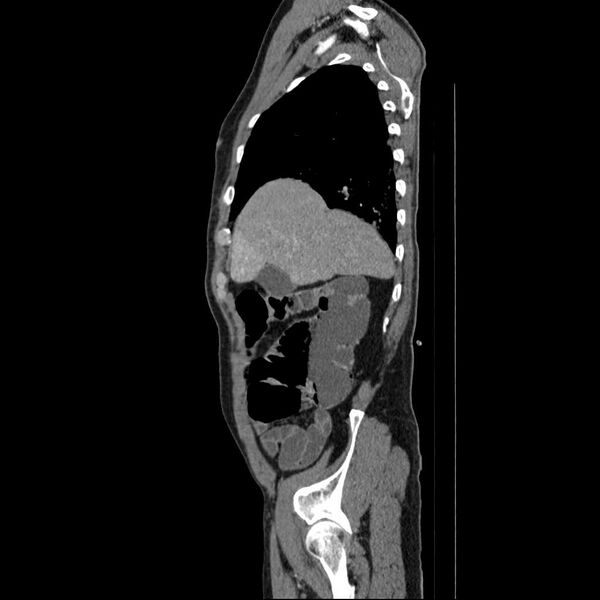 File:Aortic dissection- Stanford type A (Radiopaedia 22085-22085 D 16).jpg