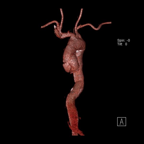 File:Aortic dissection - De Bakey type III - Stanford B (Radiopaedia 21903-21882 3D C+ arterial phase 19).jpg