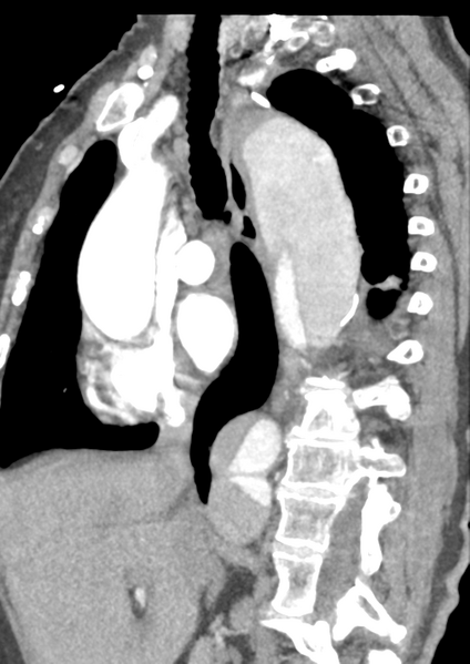 File:Aortic dissection - Stanford type B (Radiopaedia 50171-55512 C 34).png