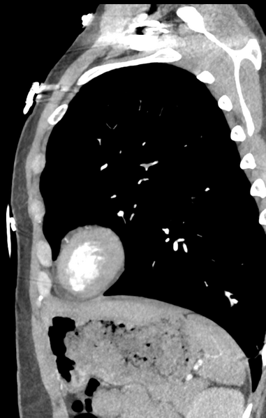 File:Aortic valve non-coronary cusp thrombus (Radiopaedia 55661-62189 C+ arterial phase 4).png