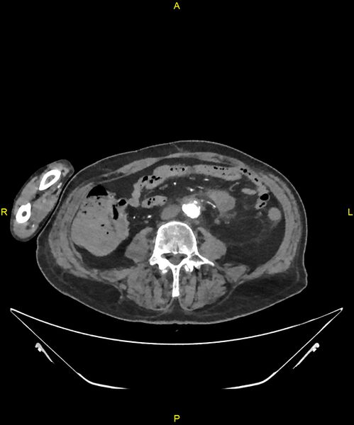 File:Aortoenteric fistula (Radiopaedia 84308-99603 B 219).jpg