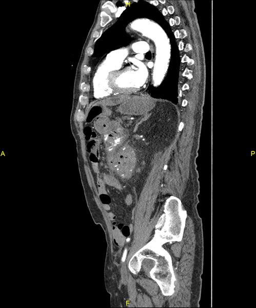 File:Aortoenteric fistula (Radiopaedia 84308-99603 C 220).jpg
