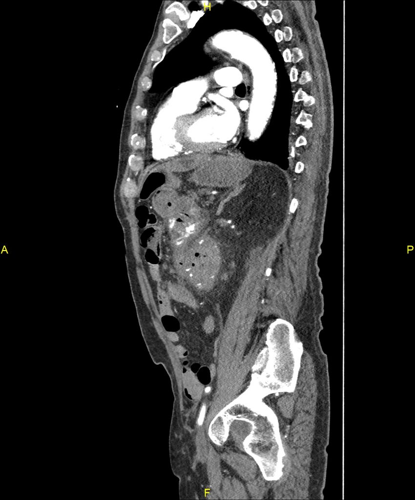 Aortoenteric fistula (Radiopaedia 84308-99603 C 220).jpg
