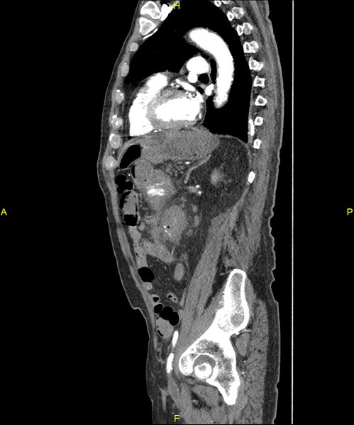 File:Aortoenteric fistula (Radiopaedia 84308-99603 C 225).jpg