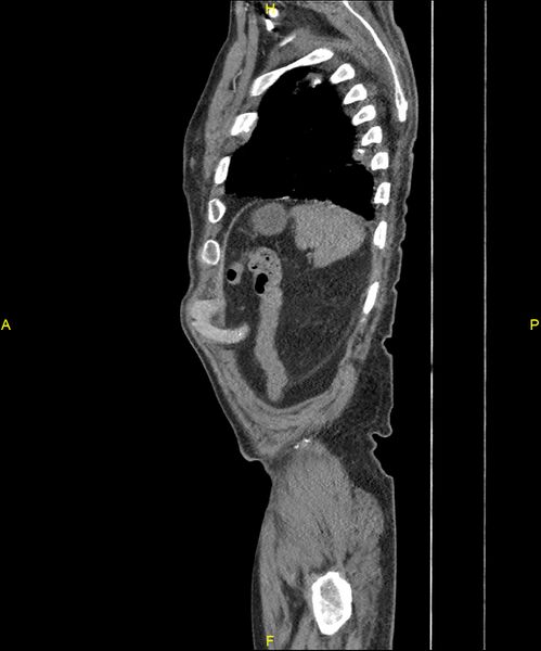 File:Aortoenteric fistula (Radiopaedia 84308-99603 C 301).jpg